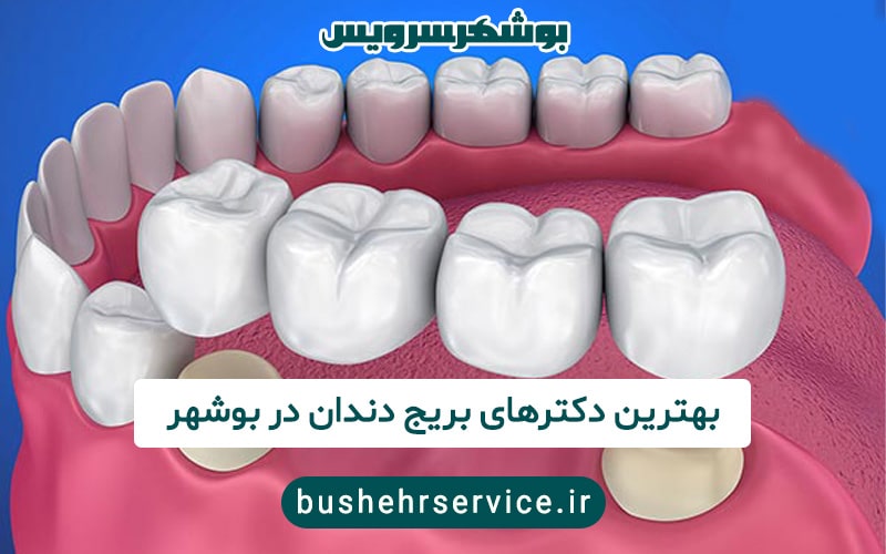 دکتر بریج دندان در بوشهر